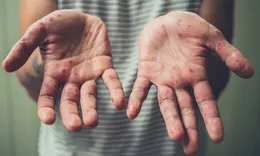 GvHD Specialist Guide: Advanced Strategies for Rebalancing Your Immune System