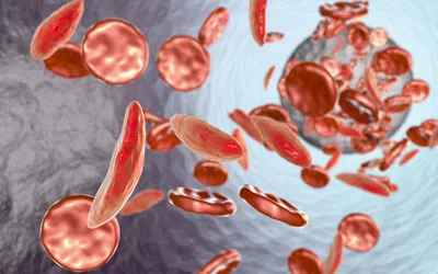 Medical illustration of sickle-shaped red blood cells among normal cells in a blood vessel.