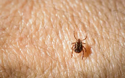A close-up of a tick attached to human skin, showing the site of the bite.