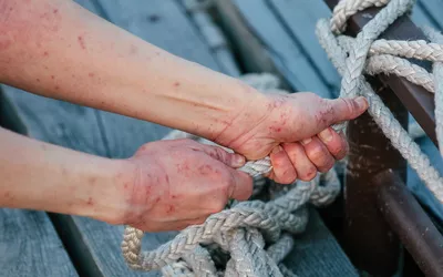 Close-up of red, irritated skin on a person's forearms.