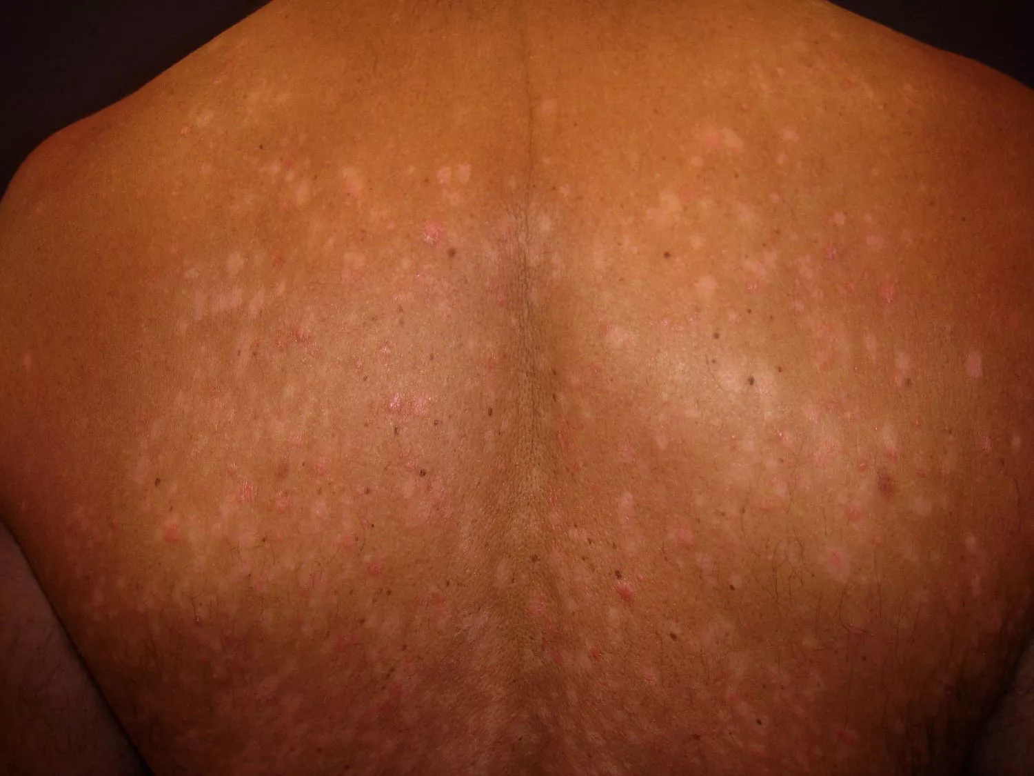 Small, drop-like red spots of guttate psoriasis spread across a patient's back.