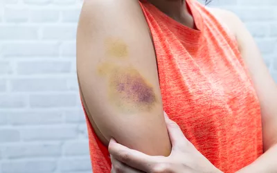 A woman holding her upper arm which displays a large, dark bruise.