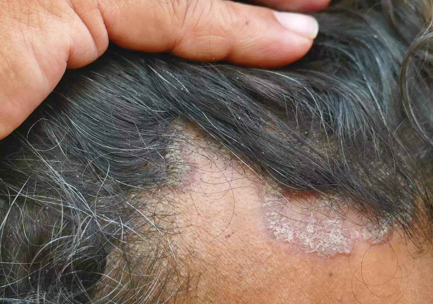 Close-up of a person's scalp showing a red, scaly patch of skin partially covered by hair.