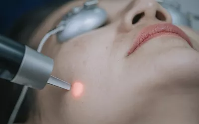 A close-up of a person receiving a red light IPL laser treatment on their face.