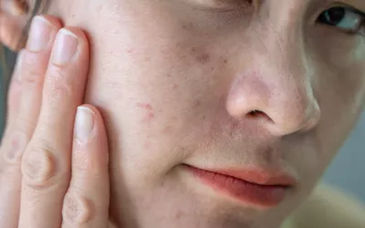 Close-up of a person's facial skin showing visible acne and texture.