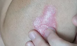 Close-up of a pink, scaly psoriasis plaque on a person's torso being touched by fingers.