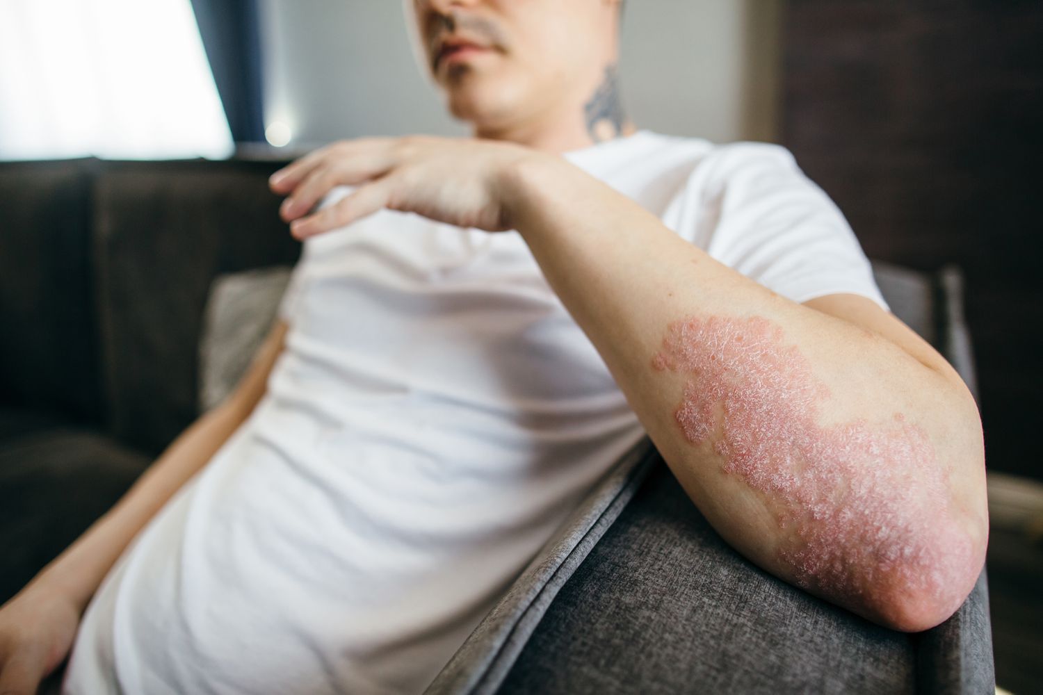 Psoriasis Management: Causes, Modern Treatments, and Holistic Lifestyle Tips